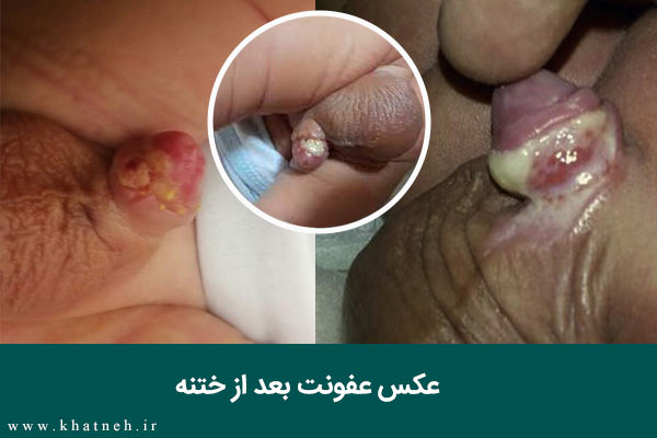 عکس عفونت  بعد از ختنه با حلقه