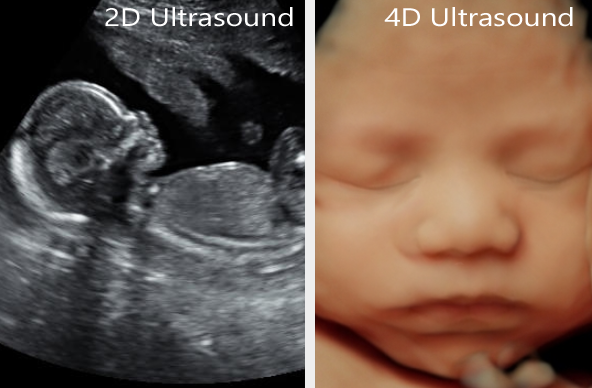 مقایسه عکس سونوگرافی بارداری دوبعدی و چهاربعدی