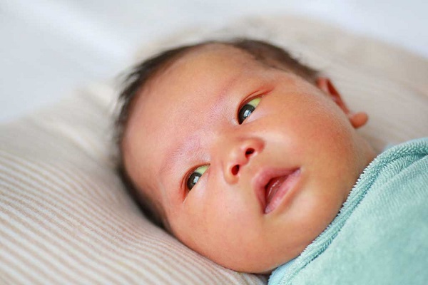 رنگ زرد پوست و قسمت صلبیه چشم در نوزادان مبتلا به یرقان نتیجه تجمع بیلی روبین غیر کونژوگه است