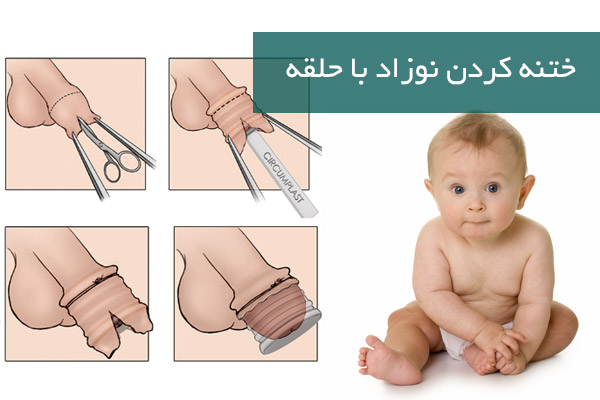 ختنه کردن نوزاد با حلقه