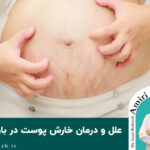 علل و درمان خارش پوست در بارداری