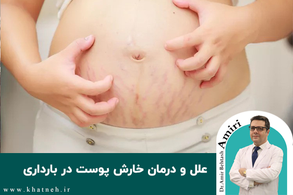 علل و درمان خارش پوست در بارداری